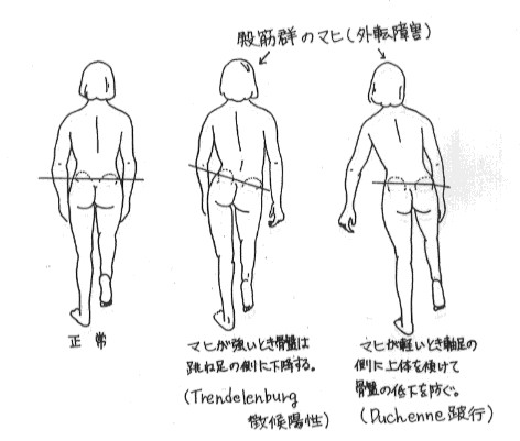 ブルグ 原因 デレン トレン 歩行